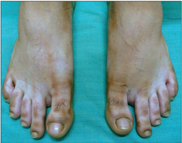 Hiện diện các vùng da mất sắc tố ở các ngón chân và bàn chân 2 bên ở một người sử dụng corticoid thường xuyên