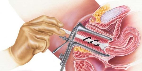 Tầm soát ung thư cổ tử cung bằng phương pháp Pap
