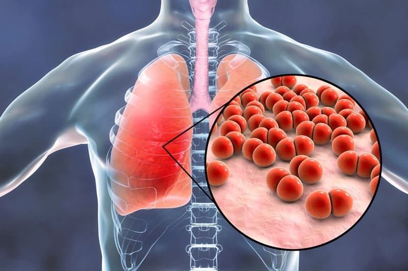 Phế cầu khuẩn gây ra nhiều bệnh lý nghiêm trọng - trong đó có viêm phổi