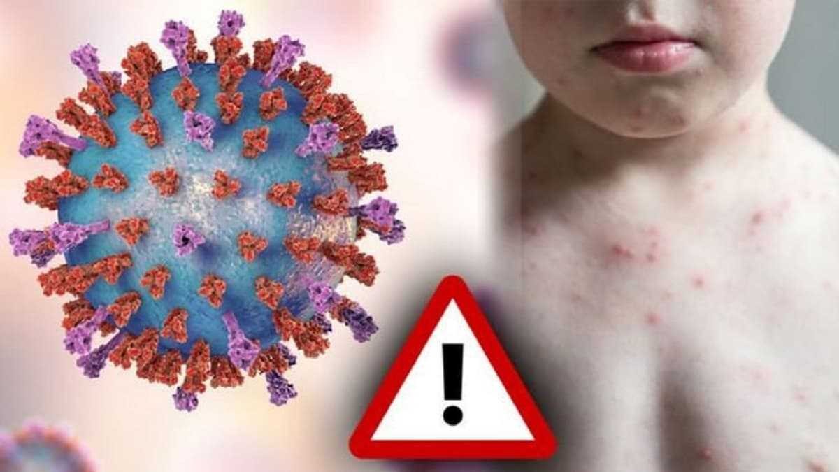 Bệnh sởi - quai bị - rubella được gây ra bởi vi-rút