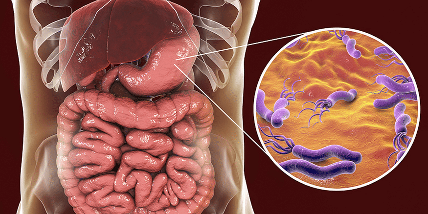 Các nghiên cứu cho thấy nhiễm vi khuẩn Helicobacter pylori có liên quan đến mắc ung thư dạ dày