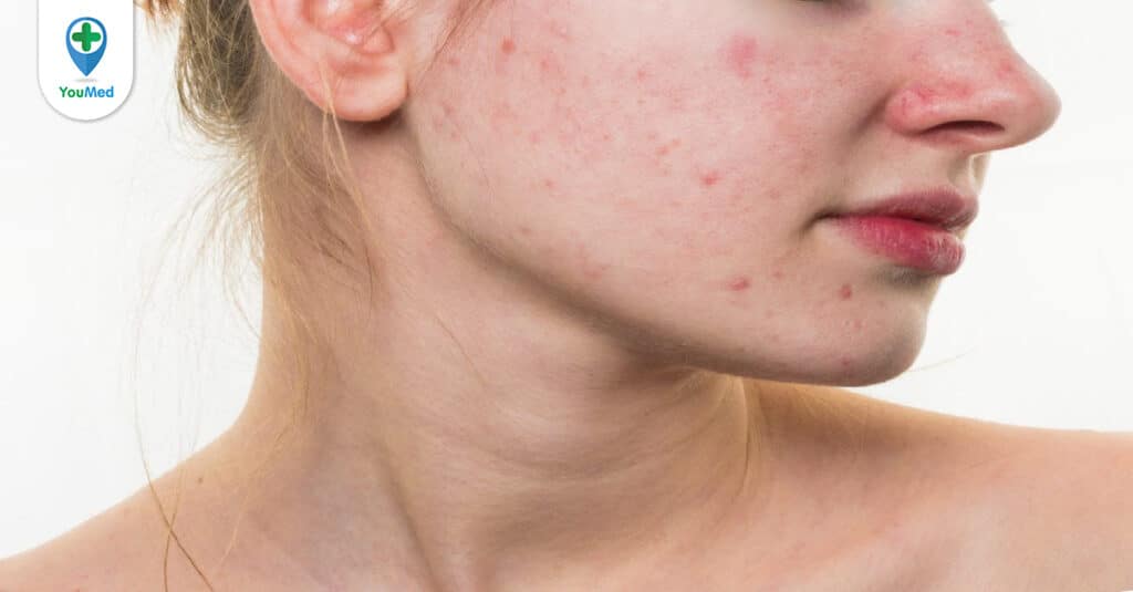 Lưu ý khi chọn kem chống nắng cho da dầu mụn