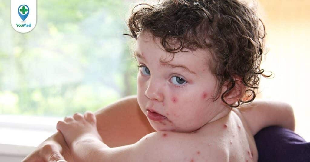 Các bệnh lý gây viêm da bóng nước, mụn nước phổ biến ở trẻ em