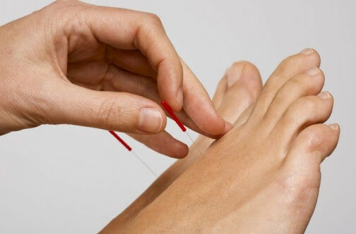 châm cứu bàn chân có nhiều tác dụng