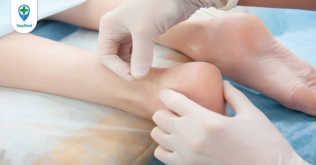 Bệnh gai gót chân có thể được điều trị bằng châm cứu?