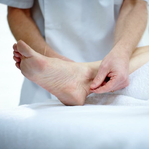 Châm cứu chữa gai gót chân là phương pháp có tác dụng giảm đau hiệu quả.