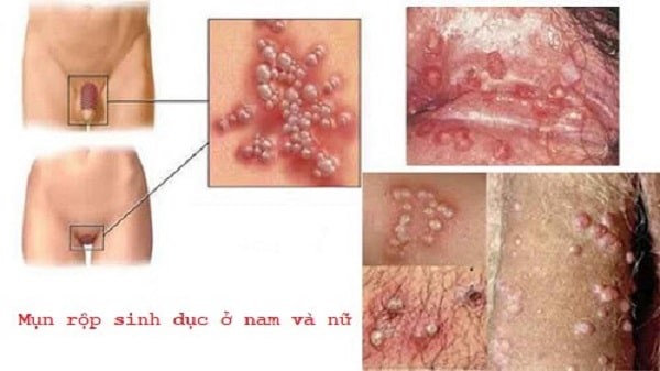 Herpes sinh dục là bệnh lý nguy hiểm cần được điều trị sớm