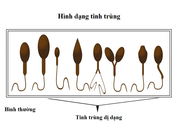 Tinh trùng bình thường và tình trùng dị dạng 