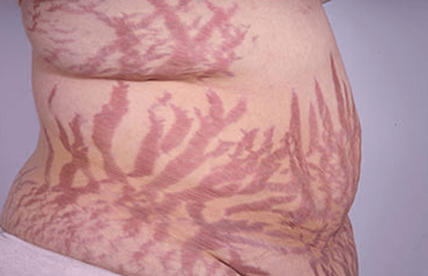 Vết rạn màu tím xuất hiện bất thường trên da có thể là dấu hiệu của hội chứng Cushing