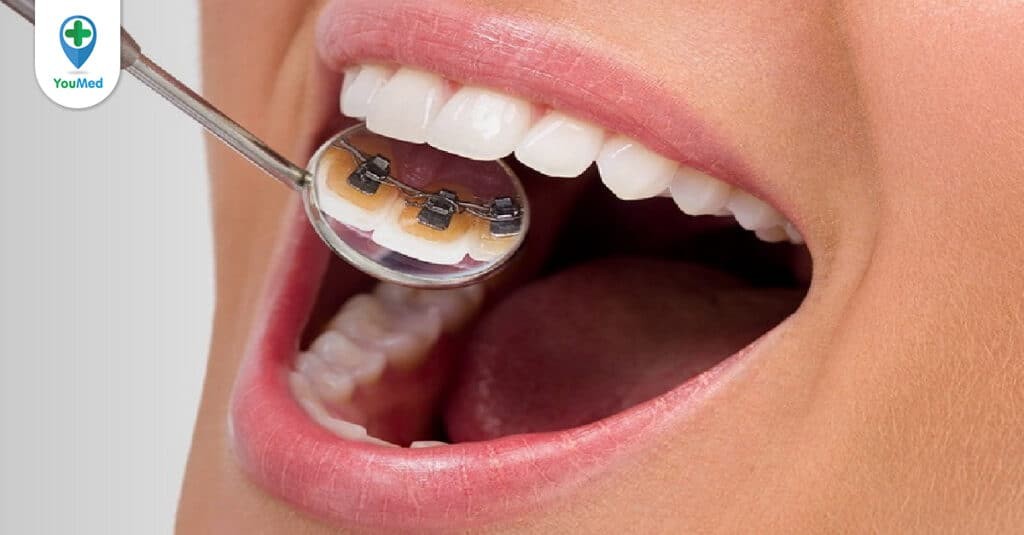 Niềng răng mặt lưỡi: Những điều bạn cần biết khi lựa chọn