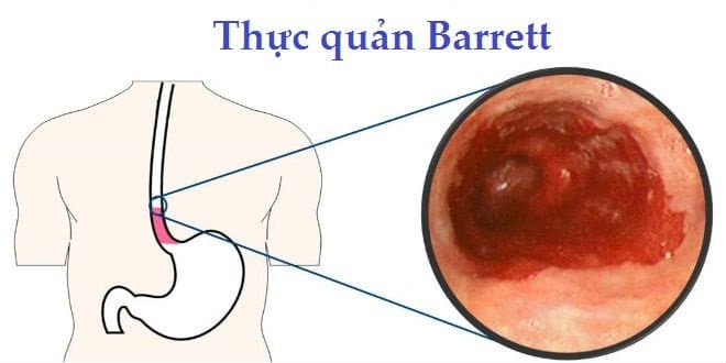 Barrett thực quản là biến chứng nguy hiểm có thể dẫn đến ung thư
