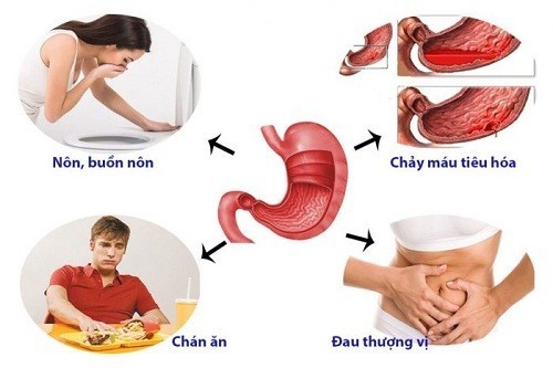 Một số triệu chứng viêm loét dạ dày