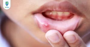 Nhiệt miệng là gì? Nguyên nhân và các cách chữa hiệu quả