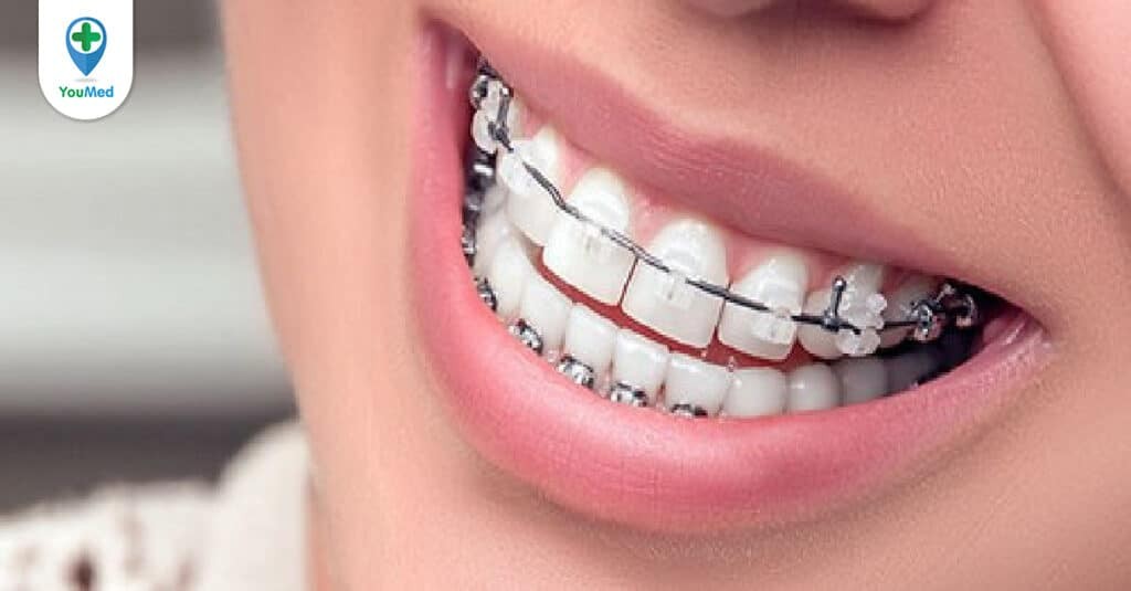 Niềng răng mắc cài sứ: Những lợi ích, lưu ý và chi phí