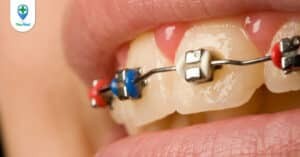 Tất tần tật về quy trình niềng răng bạn cần biết