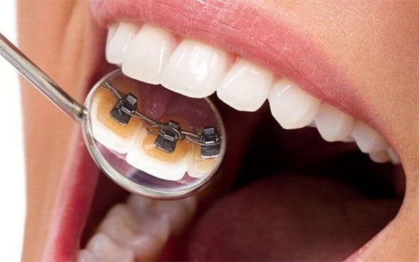 Quy trình niềng răng