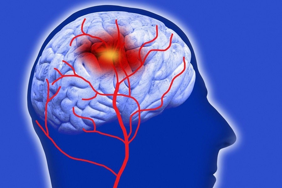 Xuất huyết não do tăng huyết áp ở người cao tuổi