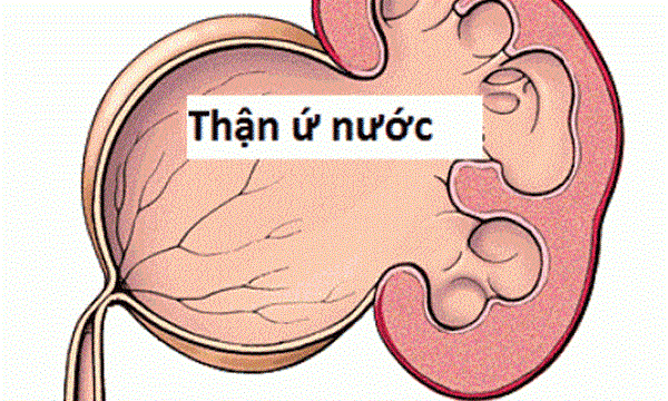 Bệnh thận ứ nước 