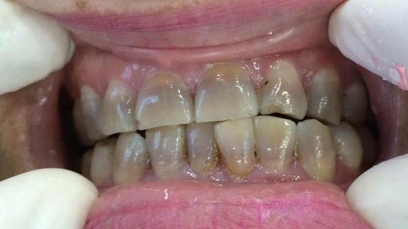 Ố răng do tetracyclin