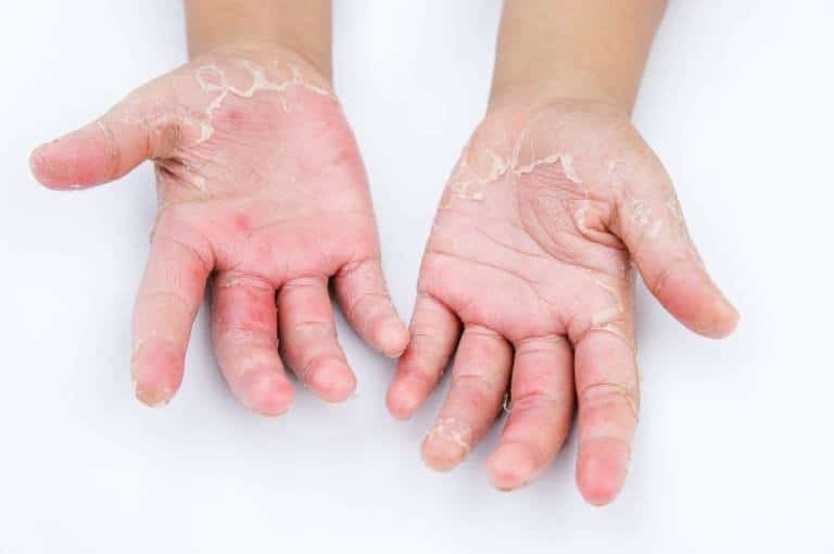 Nấm da là hậu quả của tay ẩm ướt thường xuyên