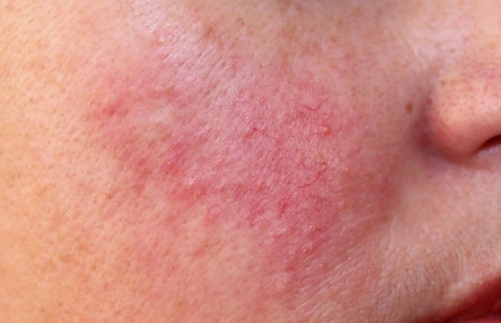 Làm gì để chăm sóc da sau khi tẩy nốt ruồi bằng laser?