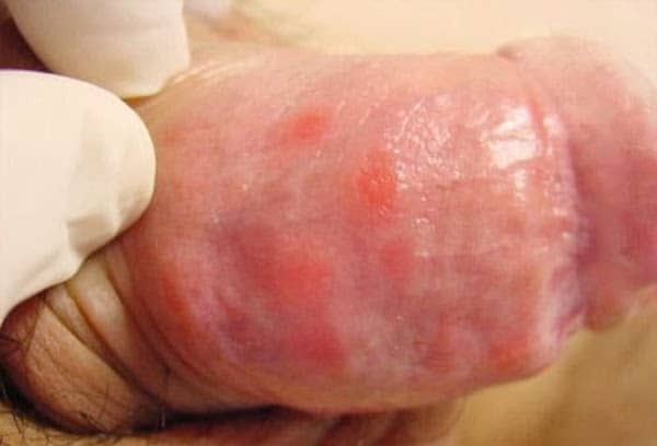Triệu chứng của bệnh giang mai thường là xuất hiện mẩn đỏ ở dương vật