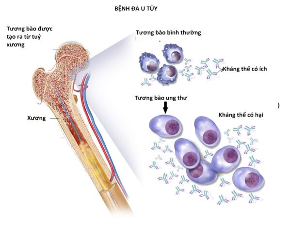 Đa u tủy xương khiến tế bào plasma ̣(tương bào) trở nên ác tính 