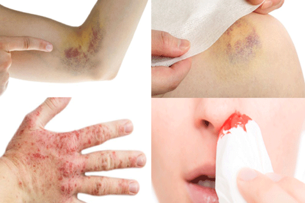 Một số triệu chứng phổ biến của bệnh ung thư máu