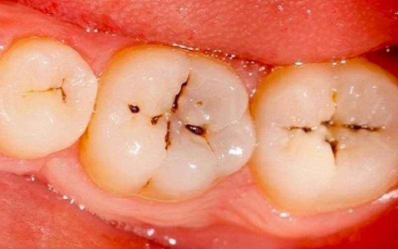 cách trị răng ố vàng
