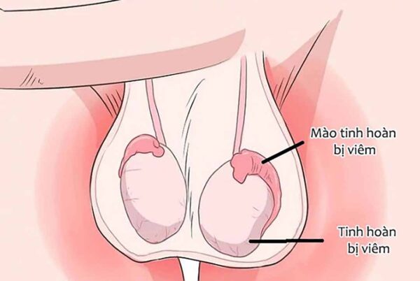 Viêm mào tinh hoàn và viêm tinh hoàn có thể làm kích thước tinh hoàn sưng to