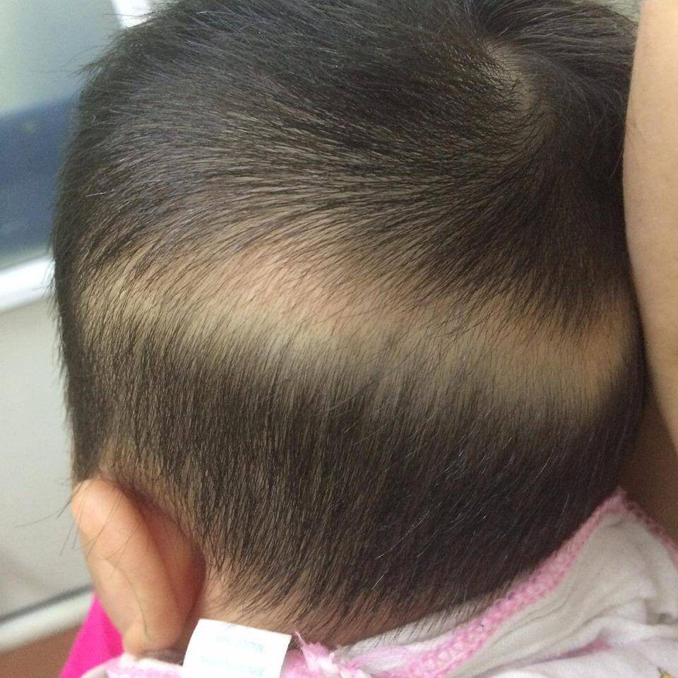 Trẻ bị rụng tóc: Những điều cần biết - YouMed