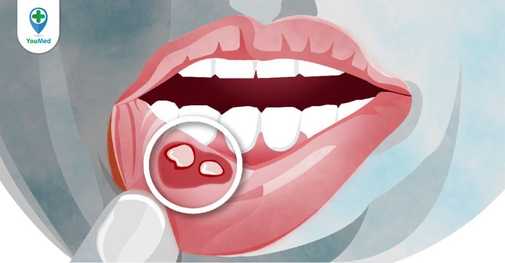 Liệu bạn đã biết những triệu chứng nhiệt miệng sau đây?