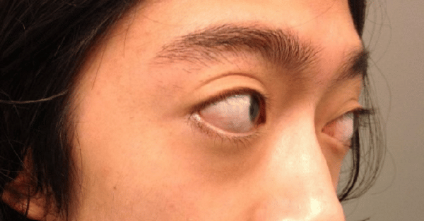 Người mắc bệnh Basedow thường có mắt lồi to ra