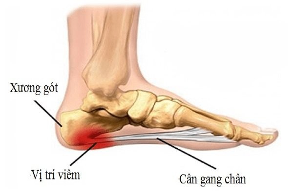 Triệu chứng điển hình của viêm cân gan chân là đau gót chân