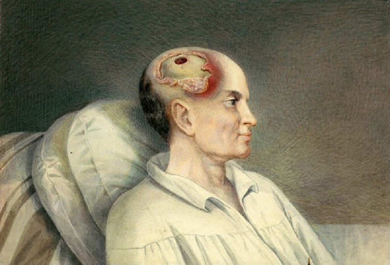 Tiền sử chấn thương đầu làm tăng nguy cơ mắc bệnh Parkinson