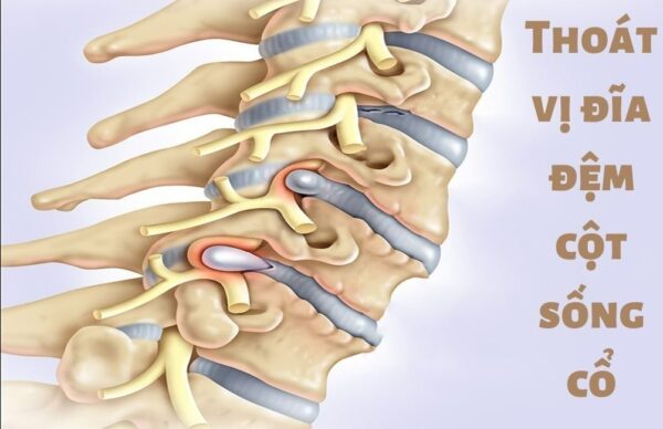 Thoát vị đĩa đệm cột sống cổ là một trong những nguyên nhân gây ra tình trạng đau cổ vai gáy