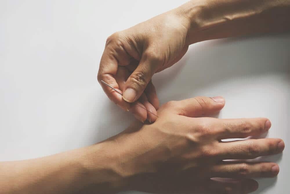 Châm cứu là một liệu pháp đông y giúp giảm triệu chứng tê tay hiệu quả