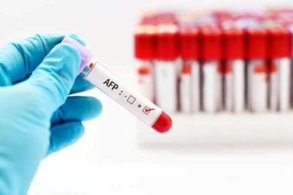Xét nghiệm định lượng AFP trong máu có thể giúp tầm soát ung thư gan