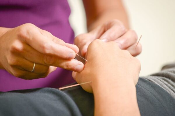 Châm cứu là một phương pháp đông y có thể giúp chữa đau cánh tay
