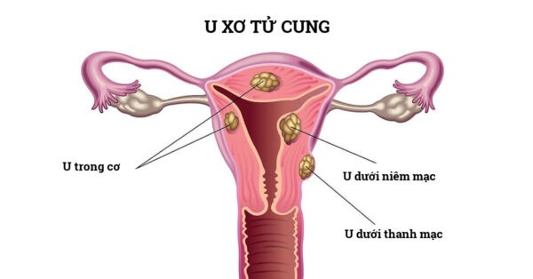 U xơ tử cung là một trong những nguyên nhân phổ biến gây vô sinh ở nữ giới