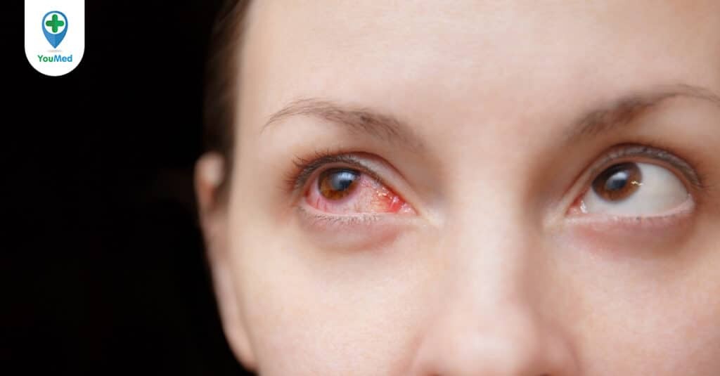 Đau mắt đỏ kiêng quan hệ: Điều này có cần thiết?