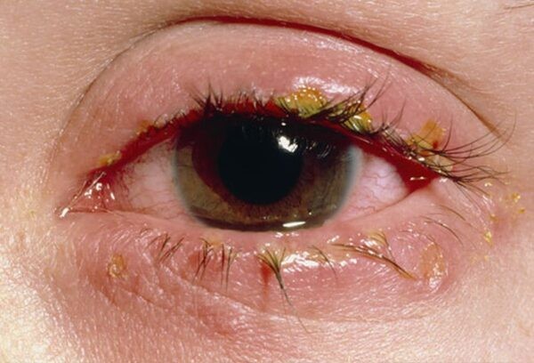 Mắt đỏ và đổ nhiều ghèn vàng là những dấu hiệu điển hình của bệnh đau mắt đỏ