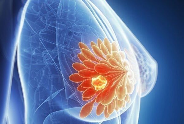 Đau nhũ hoa có thể là một dấu hiệu cảnh báo ung thư vú