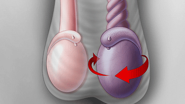 Xoắn tinh hoàn là một trong những nguyên nhân gây đau bụng dưới bên trái ở nam