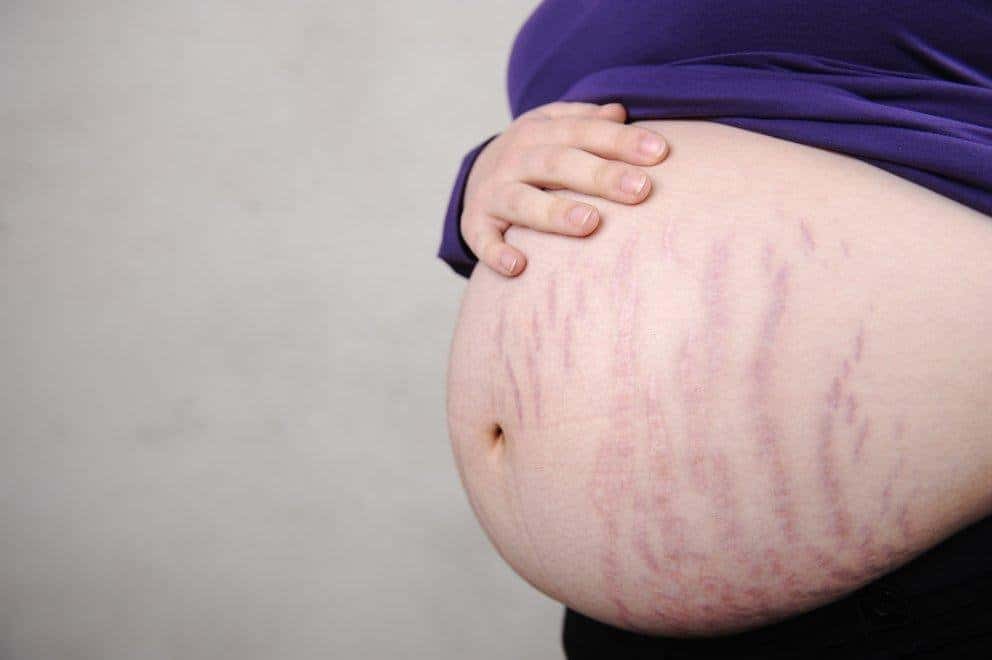 Rạn da là tình trạng khá thường gặp ở phụ nữ mang thai