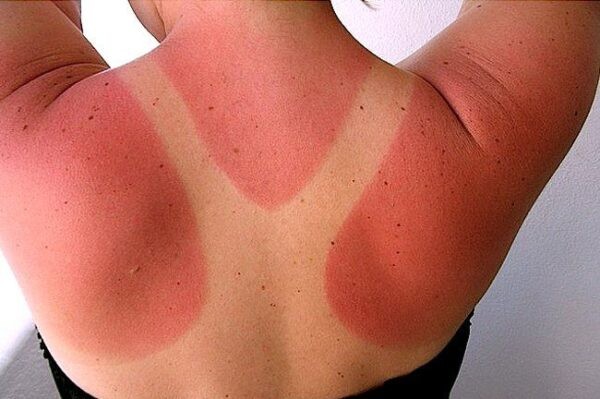 Những vùng da cháy nắng thường chuyển màu ửng hồng hoặc đỏ