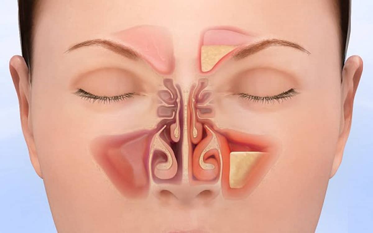 Viêm xoang là nguyên nhân thường gặp gây chảy nước mũi trong
