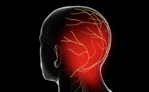 Đau đầu Arnold (đau thần kinh chẩm) thường khiến bệnh nhân cảm thấy khó chịu ở vùng sau đầu