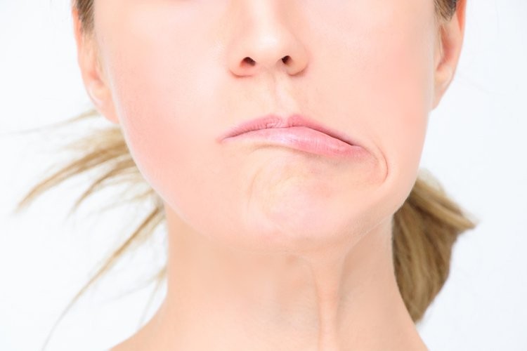 Méo miệng là một trong những dấu hiệu thường gặp của bệnh nhân bị tăng huyết áp