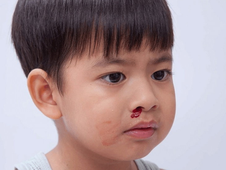 Các bất thường trong cấu trúc mũi có thể gây ra khô mũi và dẫn đến chảy nước mũi có máu